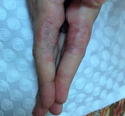 After treatment - patient after homeopathy